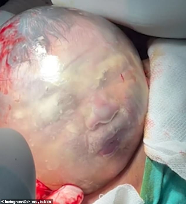 Das Baby – dessen Name nicht bekannt ist – bewegt seinen Kopf herum, öffnet und schließt seinen Mund, während Dr. Balcan seinen Kopf streichelt