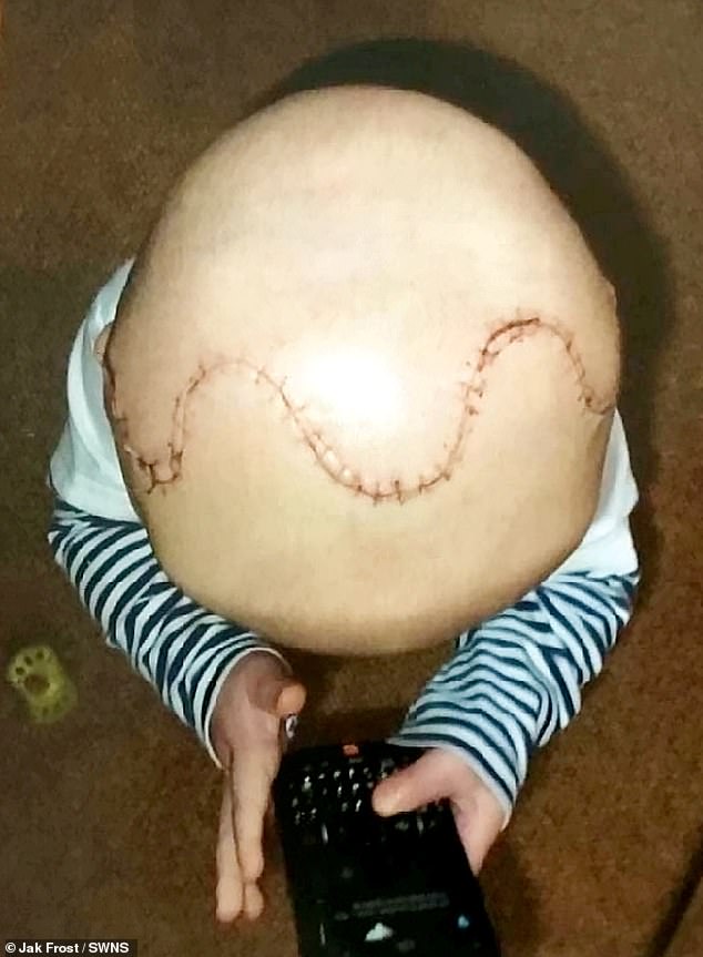 Bei der lebensrettenden Operation im Jahr 2012 mussten die Ärzte Daniels Schädel mühsam zerlegen, Stück für Stück wieder aufbauen und wie ein Puzzle wieder zusammensetzen.  Das Verfahren erzeugte eine Lücke in Daniels Kopf, sodass sein Schädel wieder zusammenschmelzen konnte, wenn er älter wurde.  Die Operation hinterließ ihm eine riesige Zick-Zack-Narbe auf dem Kopf (im Bild)