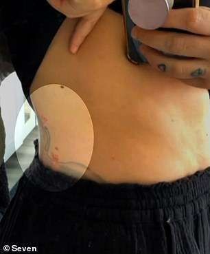 Oben im Kreis ist das krebsartige Melanom abgebildet