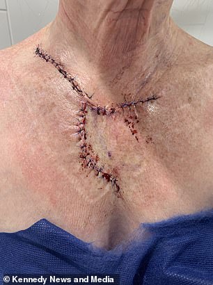 Frau Murrays Brust kurz nach der Behandlung