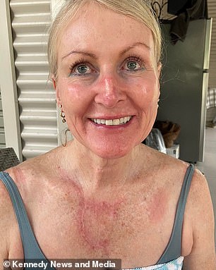 Frau Murray stellte sich vor, nachdem die Haut auf ihrer Brust und Nase verheilt war.  Sie sagte, sie werde lebenslang eine Narbe haben
