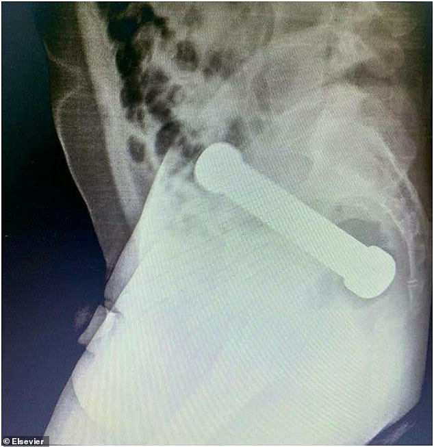 Versuche von Chirurgen, das Objekt mit medizinischen Instrumenten zu entfernen, schlugen fehl und zwangen sie, einen praktischen Ansatz zu wählen
