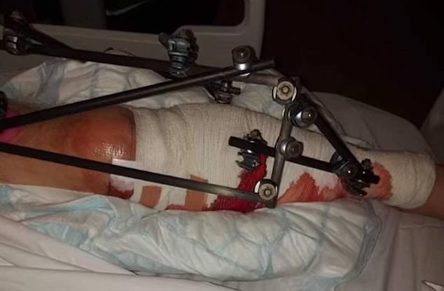 Der ehemalige Lagerarbeiter bat die Ärzte, ihm wegen der unerträglichen Schmerzen das Bein abzuschneiden – was sich schlimmer anfühlte, weil er nicht die „richtigen Medikamente“ erhielt.