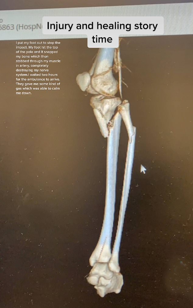 Der brutale Aufprall führte dazu, dass sein gebrochenes Schienbein den Muskel und die Arterie in seiner Wade durchbohrte, bevor das Nervensystem in seinem Bein vollständig zerstört wurde
