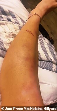 In der Notaufnahme entdeckte Hillyard, dass ihre Flecken auf einen unbekannten Fall von Leukämie zurückzuführen waren