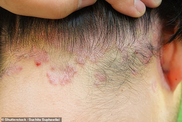 Psoriasis-Arthritis, die 100.000 Briten betrifft, weist verräterische Anzeichen sowohl für Arthritis als auch für die Hauterkrankung Psoriasis auf (Bild: Ein Patient mit Psoriasis)