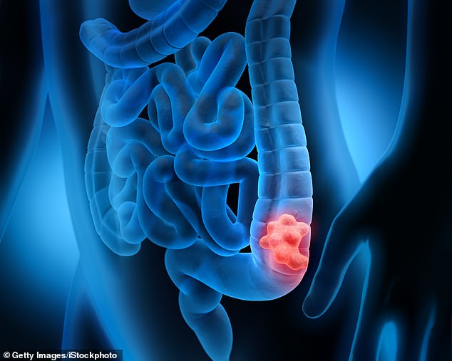 Eine kürzlich durchgeführte klinische Studie mit dem Medikament Dostarlimab, einem monoklonalen Antikörper, ergab, dass es praktisch bei jedem Teilnehmer Krebs heilte (Dateifoto)