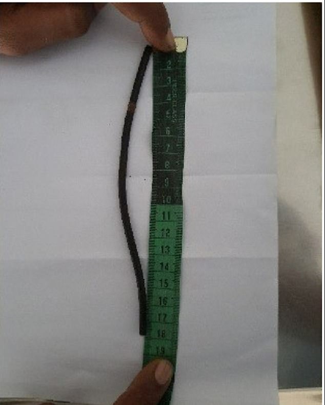 Hier ist ein Bild des 18-Nocken-Drahts (sieben Zoll) nach der Extraktion. Berichten zufolge erlitt der Mann keine unmittelbaren Komplikationen, als er entfernt wurde