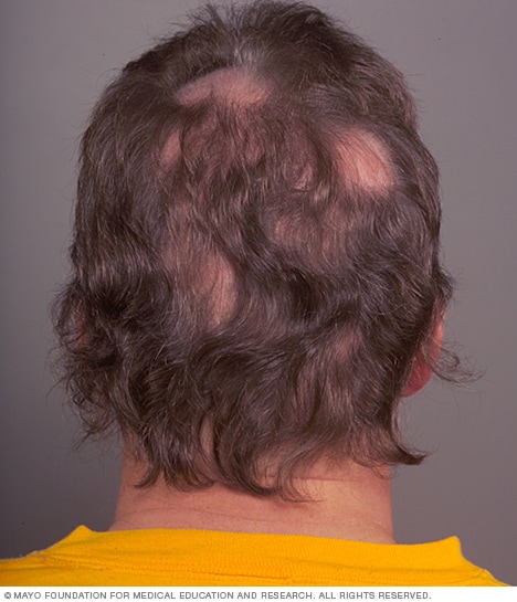 Dem fleckigen Haarausfall (Alopecia areata) geht manchmal eine juckende oder schmerzende Kopfhaut voraus.