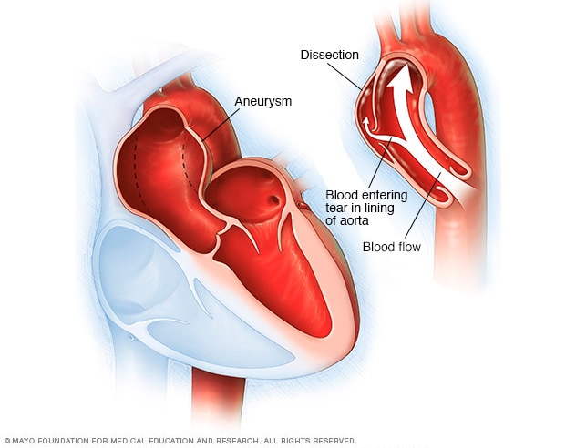 Aortenaneurysma und Aortendissektion