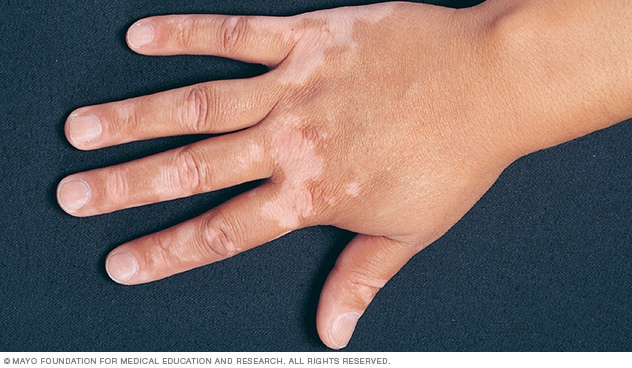 Vitiligo-Flecken auf der Oberseite der Hand
