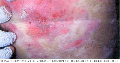 Bild zeigt dystrophische Epidermolysis bullosa 
