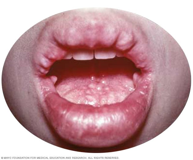 Multiple endokrine Neoplasie, Typ 2B (MEN 2B)