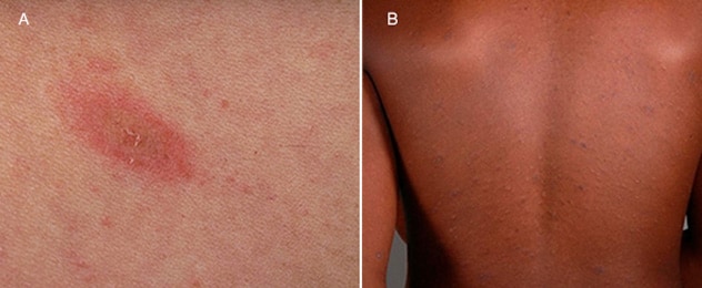 Pityriasis rosea kann mit einem Vorbotenfleck beginnen, der verschwindet. Bald darauf entwickelt sich ein sich ausbreitender Hautausschlag in einem verzweigten Muster.