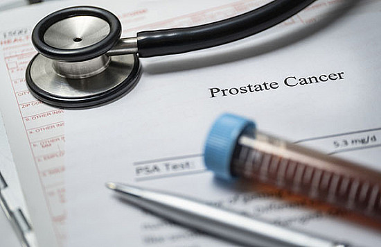 Prostatakrebs: Die Strahlentherapie erhöht das Risiko für zukünftige Krebserkrankungen