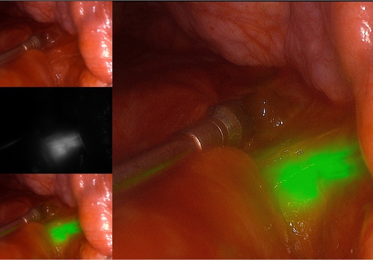 Eine genauere Lungenknotenbiopsie: Kombination von formempfindlicher Bronchoskopie mit mobiler 3D-Bildgebung