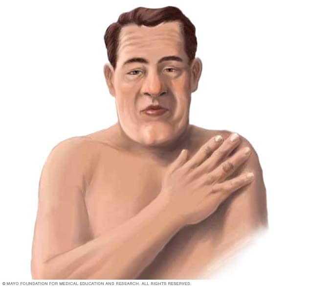 Person mit Akromegalie