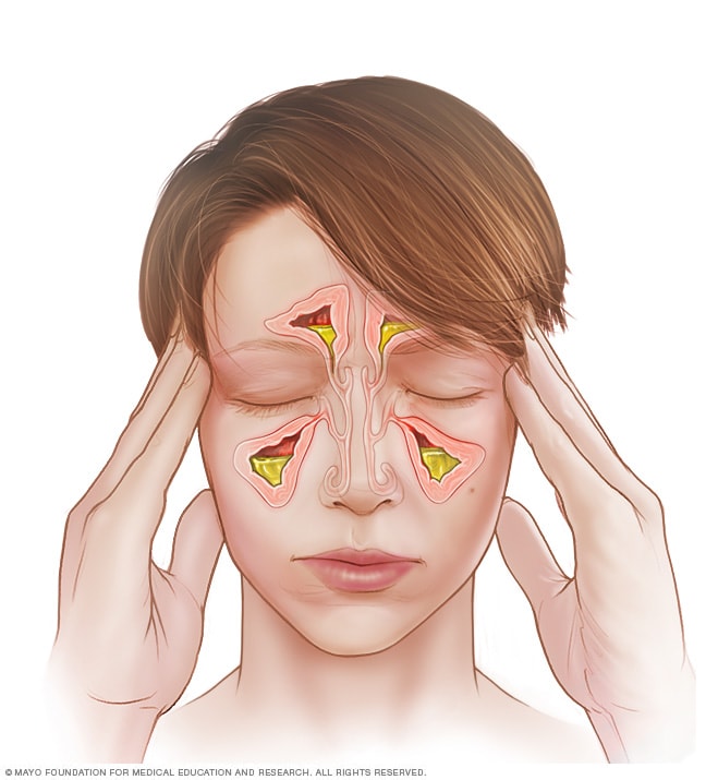 Akute Sinusitis