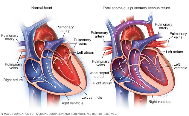 Total anomaler pulmonalvenöser Rückfluss