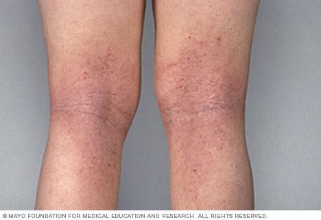 Atopische Dermatitis an den Beinen