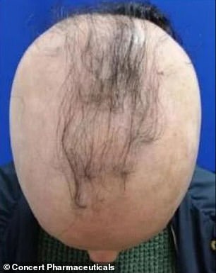 Beeindruckende Fotos zeigen die Wirkung von Alopezie-Medikamenten, die bei 40 % der Patienten den vollen Haarschopf nachwachsen lassen – was Tausenden von Jada Pinkett-Smith mit Glatzenbildung Hoffnung gibt