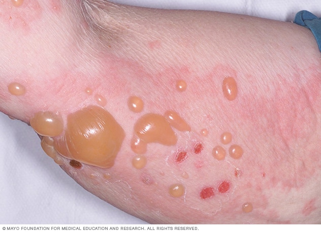 Bullöses Pemphigoid