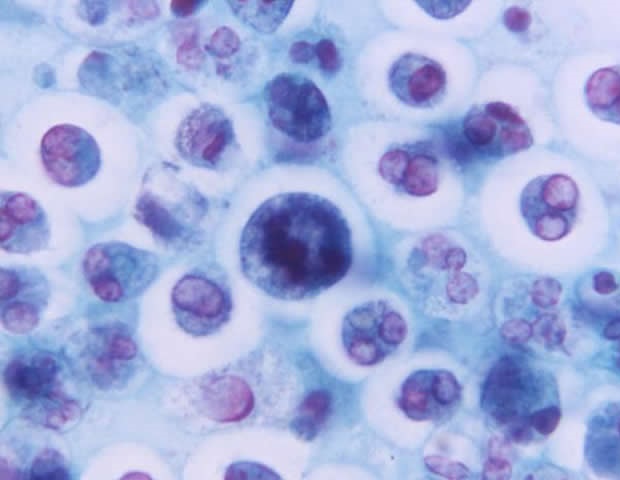 Chemokine sind wahrscheinlich mit dem Risiko einer osteoporotischen Hüftfraktur bei älteren Männern verbunden