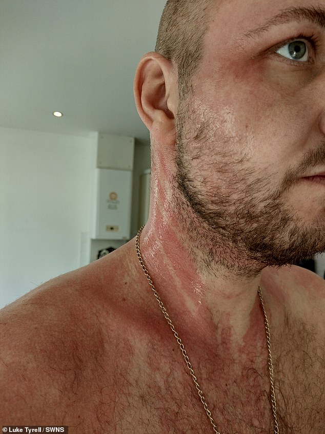 Der 34-jährige Friseur, der unter einer allergischen Reaktion auf Johnsons Babyshampoo litt, sagt, es habe sich wie eine „Säureverbrennung“ im Nacken angefühlt
