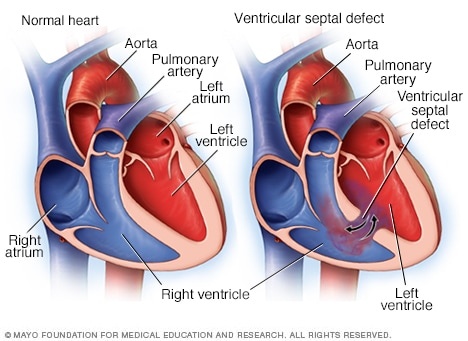 Ventrikelseptumdefekt