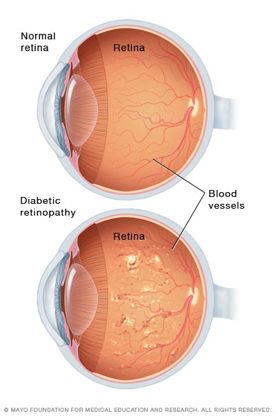 Schwere nichtproliferative diabetische Retinopathie
