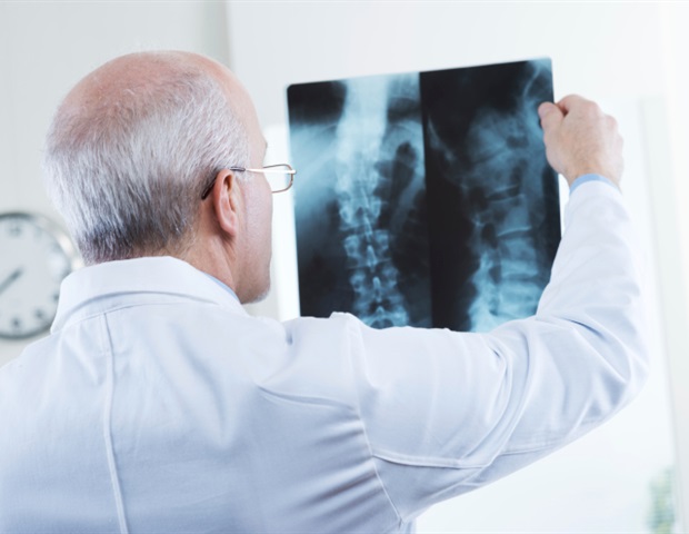 Es wurde festgestellt, dass Wirbelsäulenerkrankungen bei CRMO-Patienten häufiger auftreten als bisher angenommen