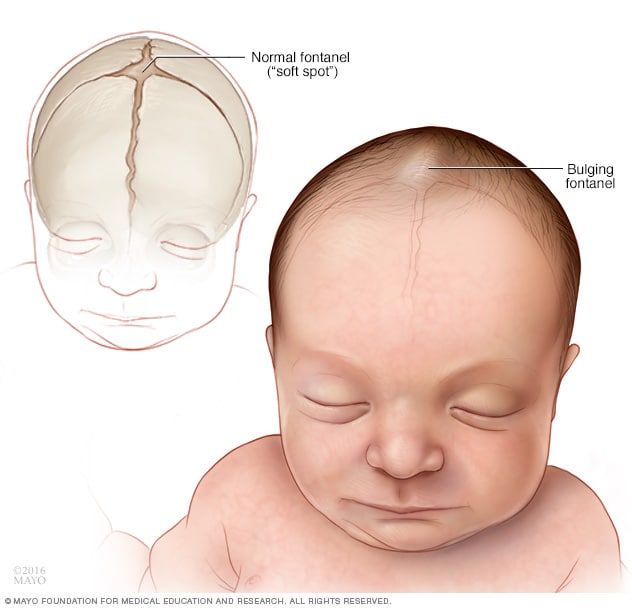 Normale vs. abnormale weiche Stellen (Fontanellen) am Schädel eines Babys