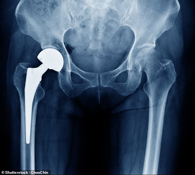 Britische Forscher haben herausgefunden, dass DNA-Signale, die in Speichel- und Blutproben lauern, mit einer nachteiligen Reaktion auf Materialien in den meisten Gelenkimplantaten in Verbindung stehen.  Etwa 15 % der Briten haben diese genetischen Eigenschaften, die das Immunsystem veranlassen, Gewebe um das Material herum anzugreifen, was Schmerzen und Schwellungen verursacht