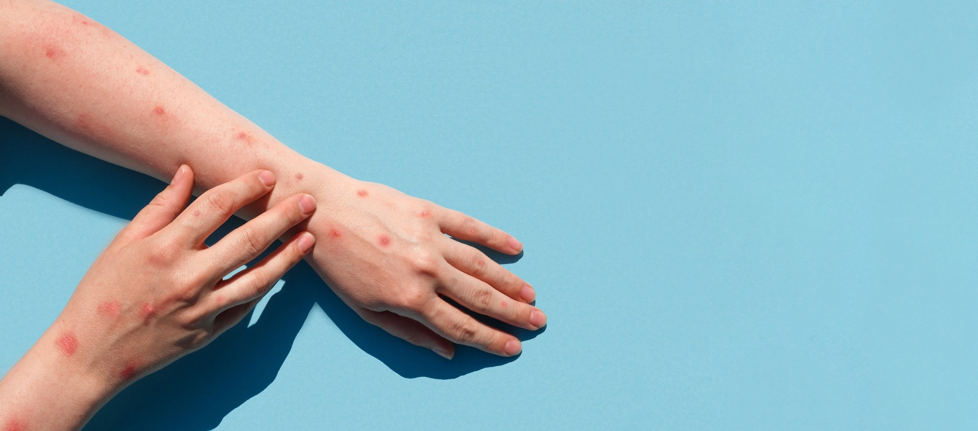 Studie: Die Struktur der 2'-O-Ribose-Methyltransferase VP39 des Affenpockenvirus im Komplex mit Sinefungin bildet die Grundlage für das Inhibitordesign. Bildnachweis: Marina Demidiuk/Shutterstock Studie: Die Struktur der 2'-O-Ribose-Methyltransferase VP39 des Affenpockenvirus im Komplex mit Sinefungin bildet die Grundlage für das Inhibitordesign. Bildnachweis: Marina Demidiuk/Shutterstock