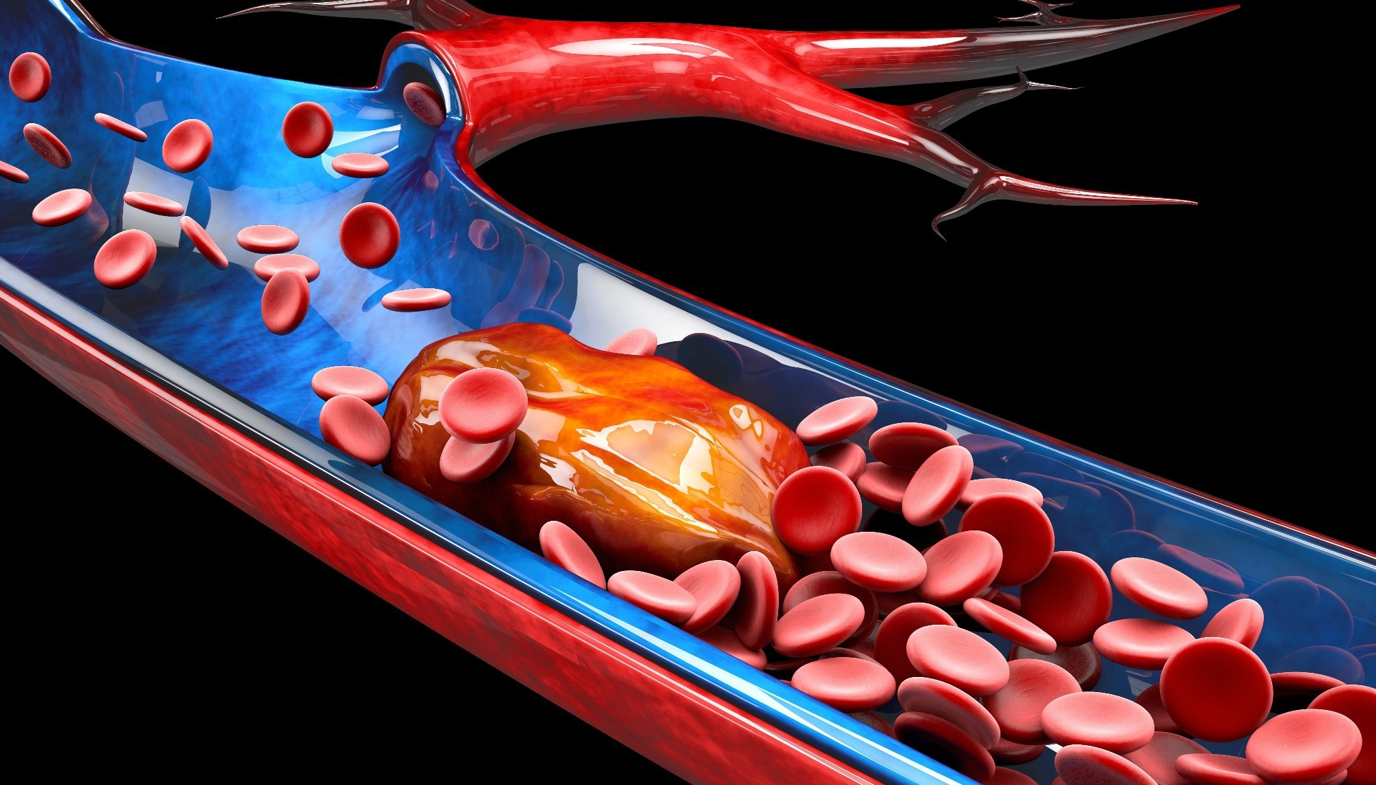 Studie: Subtypspezifische Plasmasignaturen der thrombozytenbezogenen Proteinfreisetzung bei akuter Lungenembolie. Bildquelle: Victor Josan/Shutterstock Studie: Subtypspezifische Plasmasignaturen der thrombozytenbezogenen Proteinfreisetzung bei akuter Lungenembolie. Bildquelle: Victor Josan/Shutterstock