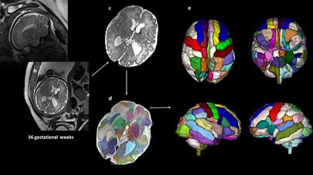 Forscher des Boston Children's Hospital untersuchten Ultraschalluntersuchungen von 40 Babys vor ihrer Geburt.  Im Bild: Ultraschalluntersuchung des Gehirns des ungeborenen Babys (a und b);  ein verarbeitetes Bild des Scans, um es von anderen Körperteilen des Babys und der Mutter zu entfernen (c);  der durch Farben segmentierte Gehirnscan, um die verschiedenen Teile zu zeigen (d);  3D-Versionen des Gehirns basierend auf den Scanergebnissen