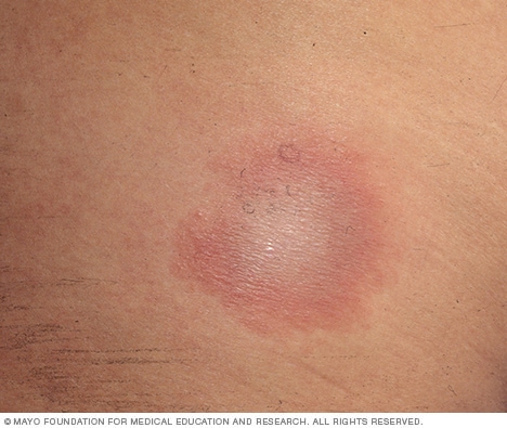 Bull's-Eye-Ausschlag, charakteristisch für Lyme-Borreliose
