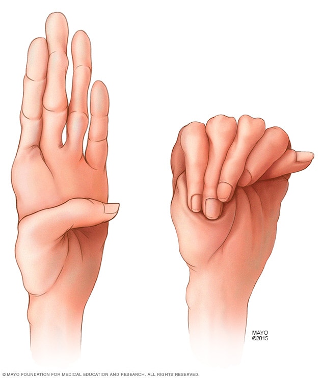 Abnormal lange Finger, die beim Marfan-Syndrom häufig vorkommen