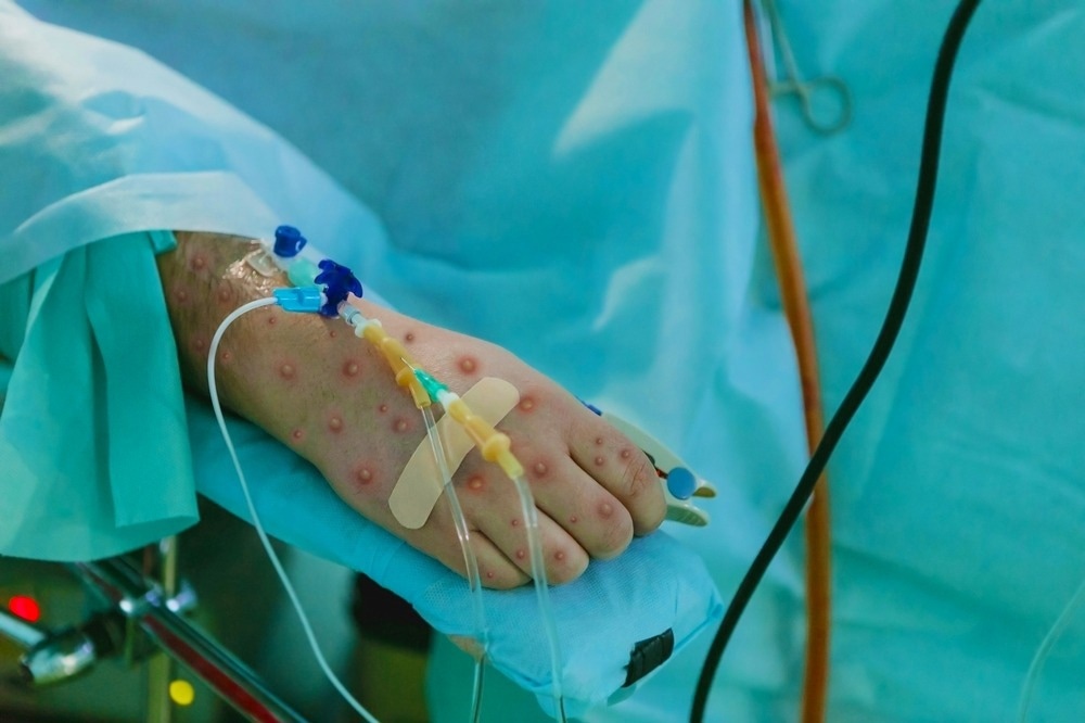 Neuer Bericht über die Auswirkungen von Affenpocken auf Menschen mit HIV