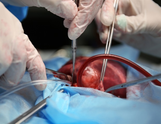 Die molekulare Signatur könnte mechanistisch mit dem Blutungsrisiko nach einer Herzoperation zusammenhängen