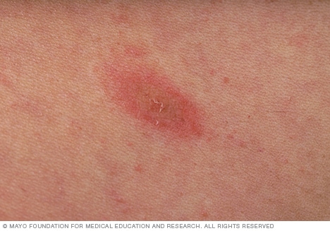Herald Patch von Pityriasis rosea