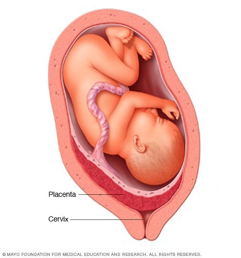 Platzierung von Plazenta und Placenta praevia