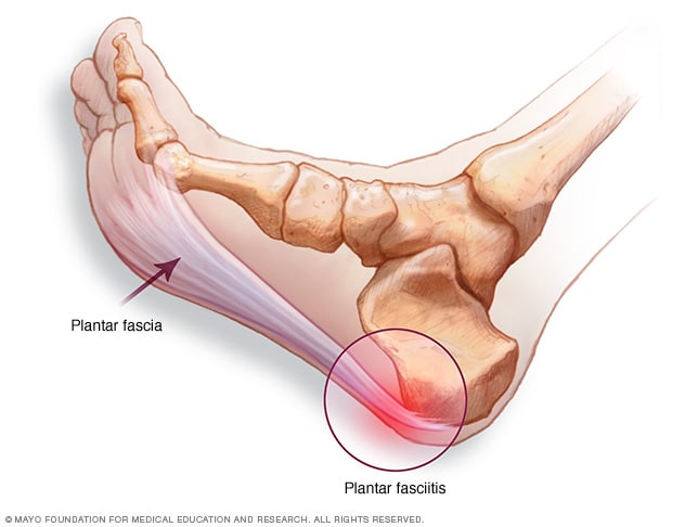 Plantarfaszie und Ort der Fersenschmerzen 