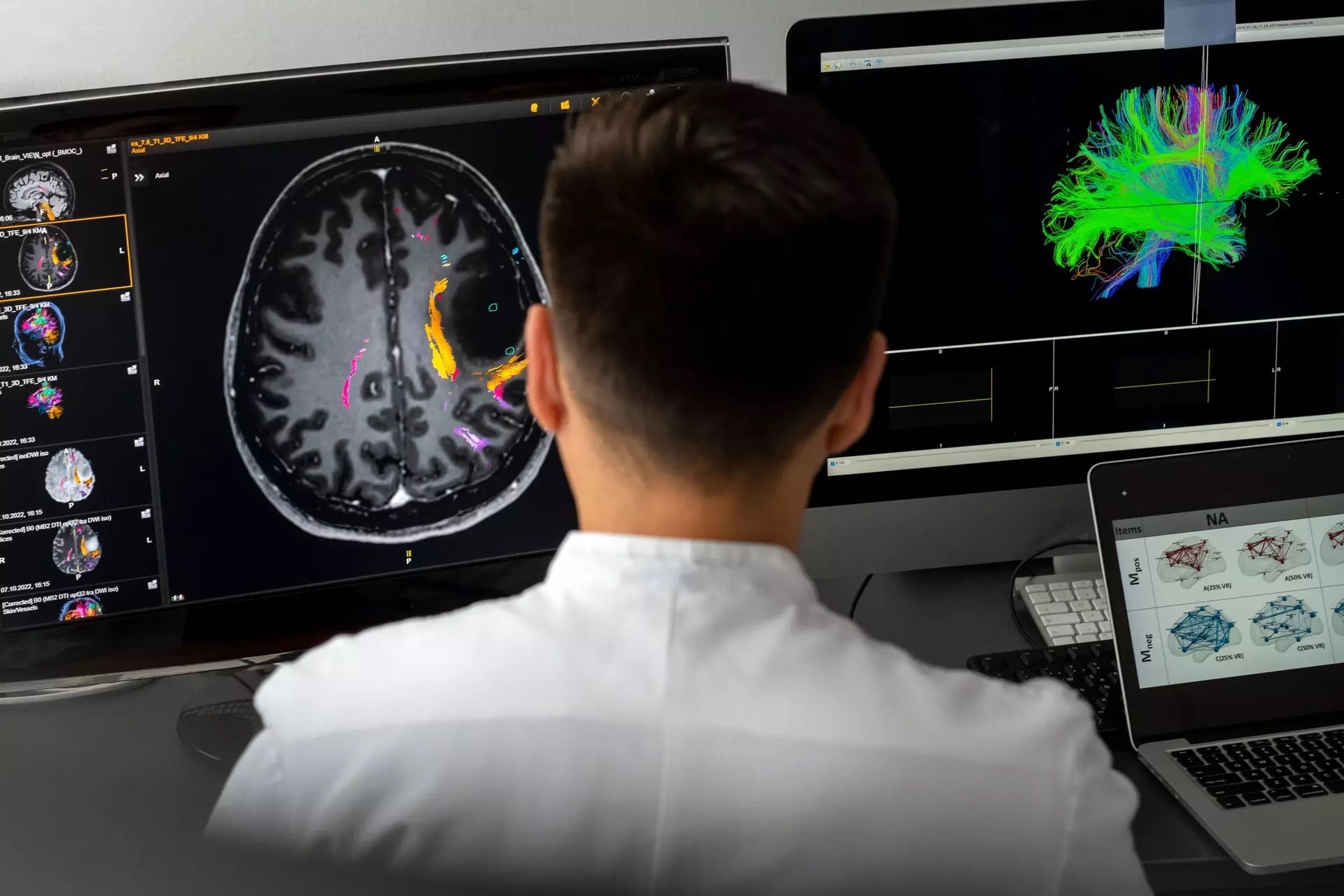 Quantifizierung des Risikos einer operationsbedingten Aphasie nach Hirntumorentfernung