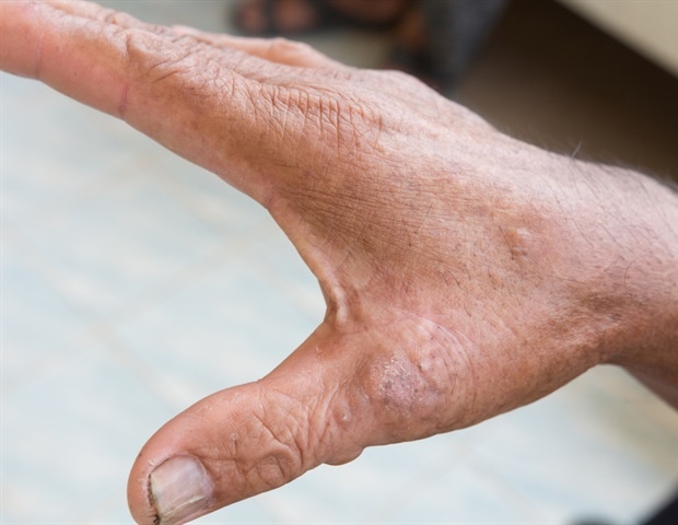 RIT-Professor erhält Stipendium zur Erforschung neuer Therapieansätze für Sklerodermie