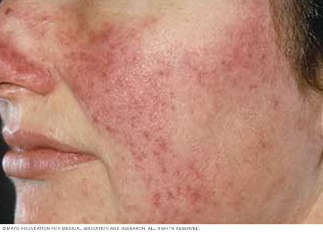 Rosacea auf heller Haut