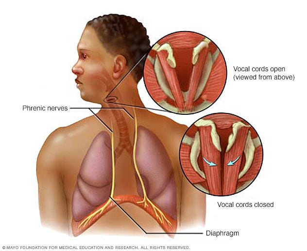 Illustration, die zeigt, was Schluckauf verursacht