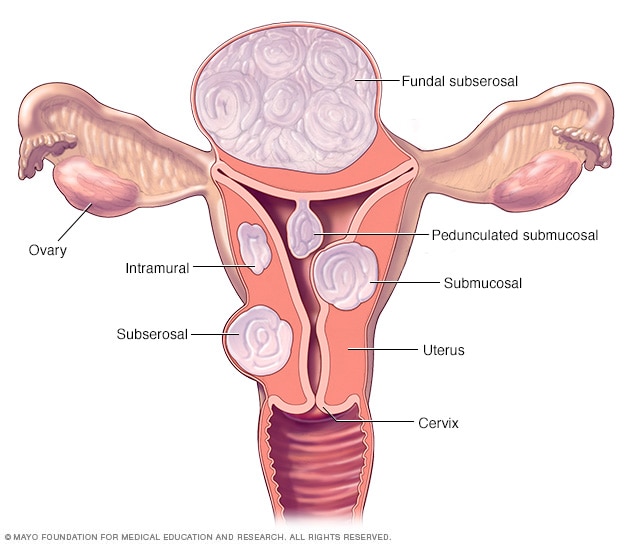 Verschiedene Arten von Uterusmyomen und ihre Lage