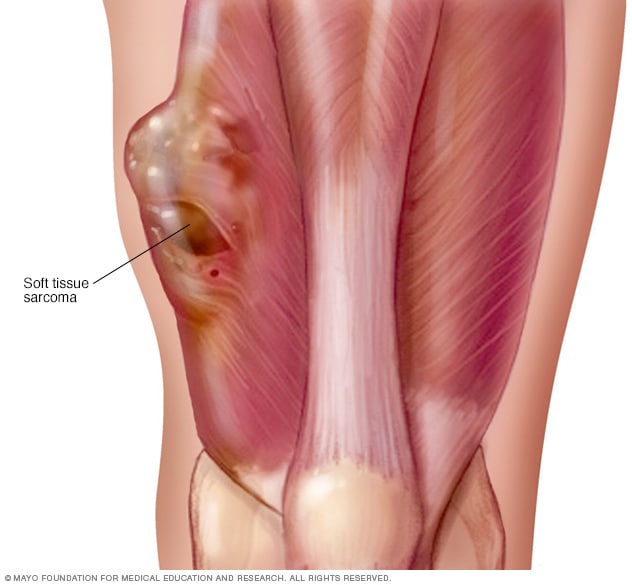 Tumor im Oberschenkelmuskel