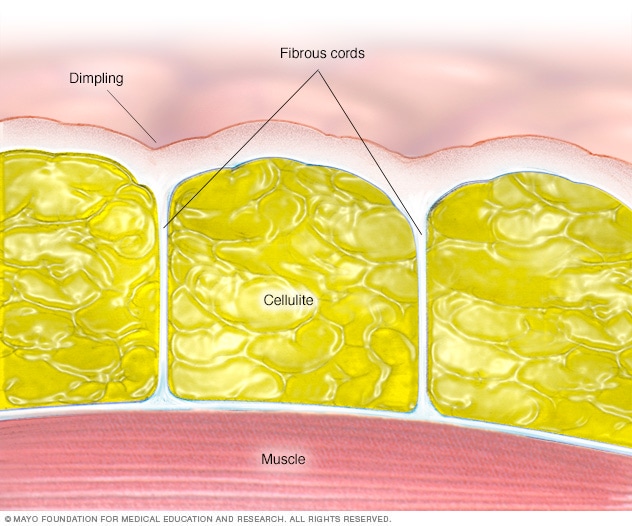 Anatomie der Cellulite